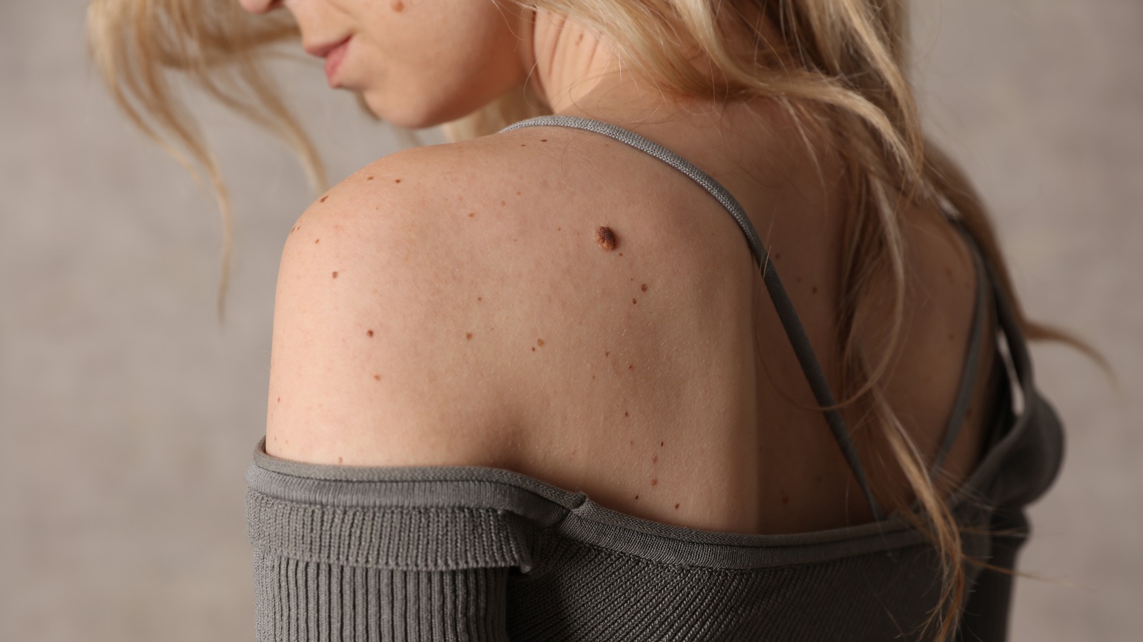Can High Cholesterol Cause Skin Tags? Here’s What We Know – Health Digest